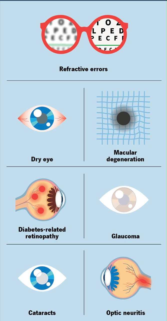 Pterygium on eye