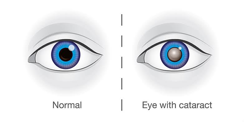 Pterygium on eye
