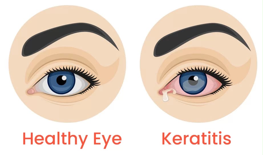 Pterygium on eye